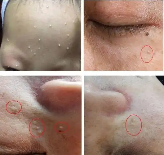 粟丘疹案例分享_粟丘疹_介绍_症状表现 - 好大夫在线