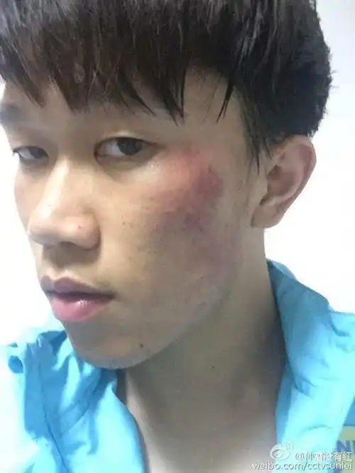 谢鹏飞脸被打伤(图片来源微博@孙雷没有红 )