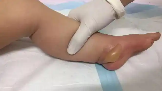 18个月宝宝被热水袋烫成这样!哪些取暖神器才靠谱?