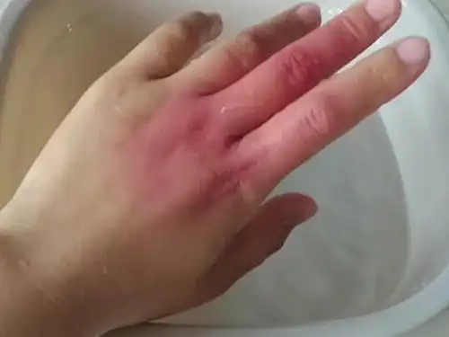 烫伤后怎么处理(手上烫伤水泡怎么处理)-品牌探索