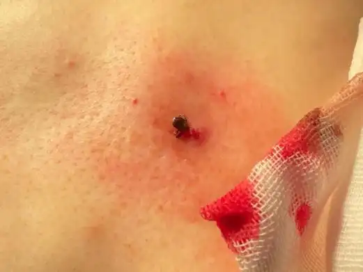 虫子小蜱气大身上冒出小黑点别大意