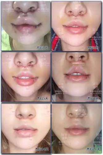 口角上提手术_唇部整形_治疗介绍_治疗准备_费用_护理及注意事项 - 好