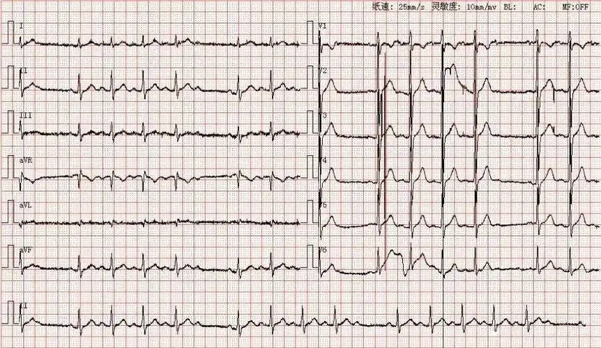 心电图图库丨二度ii型(2:1)房室传导阻滞系列 - 知乎