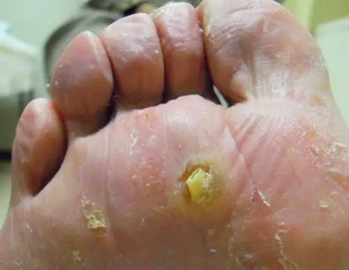 脚底胼胝增生图片