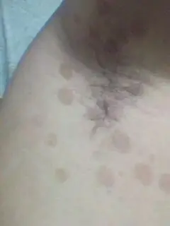 腋窝下的红斑点