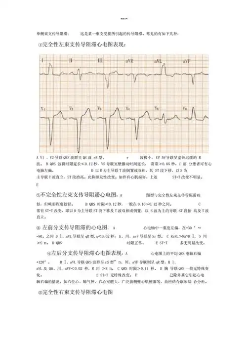 完全性左束支传导阻滞心电图.docx 3页