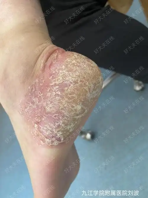 掌跖脓疱病_脓疱疮 - 好大夫在线