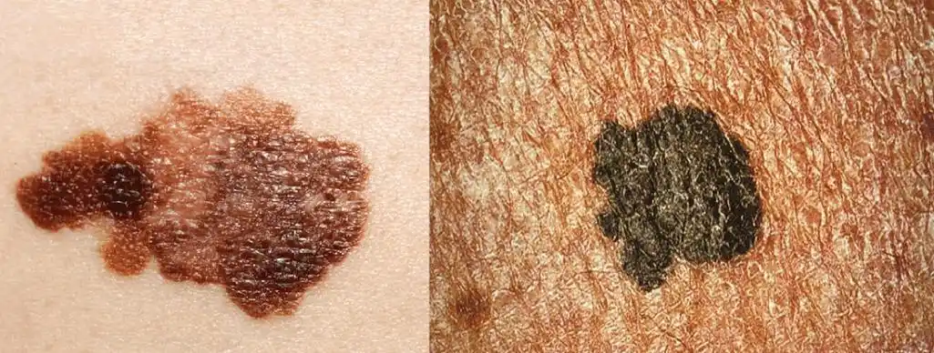 "黑色素瘤"相关话题也冲上热搜,引发广大网友关注.