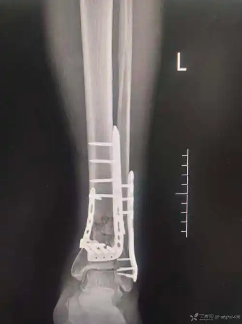 胫腓骨远端粉碎性骨折