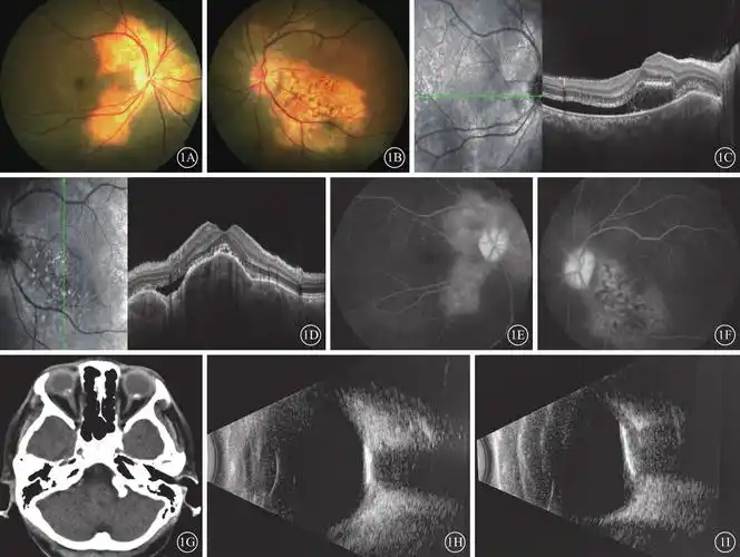 双眼脉络膜骨瘤一例