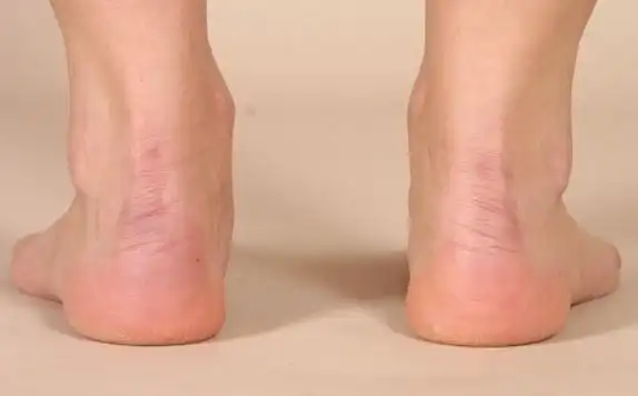 脚后跟的筋疼是怎么回事脚后跟筋疼是什么原因图
