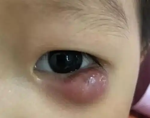 4岁男孩眼睛红肿长霰粒肿差点留疤