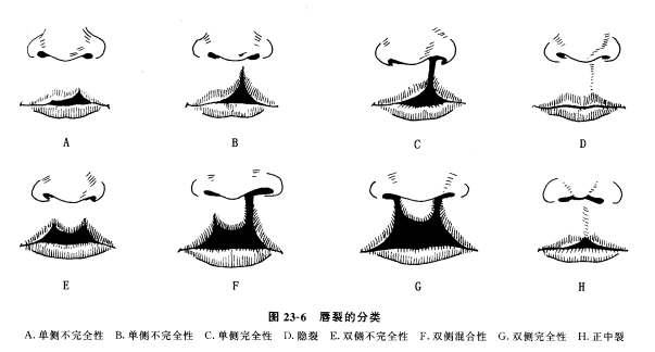兔唇患儿(唇裂)什么时候做手术?修复有哪些要求?