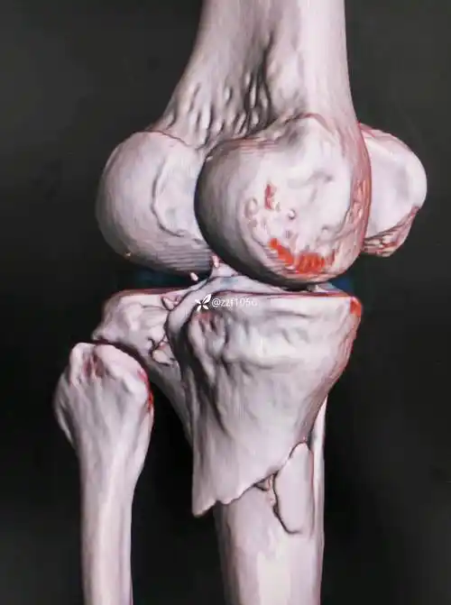 45岁schatzker4型胫骨平台骨折