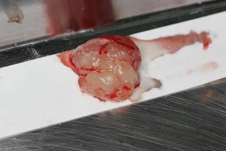 牙龈瘤微创摘除3例