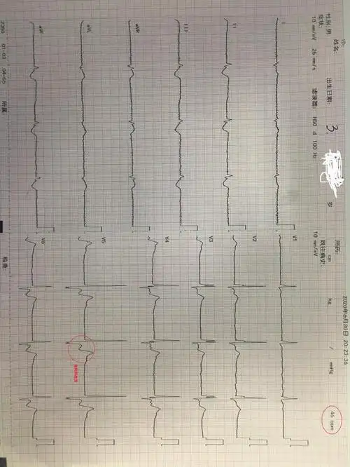 生理状况波动比较大,对一些早期中毒改变不敏感,因此地高辛中毒并不是