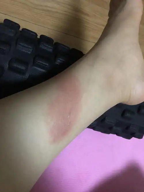 不小心被开水烫伤是不是不能跑步