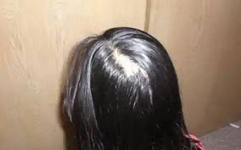 女性头顶脱发图片