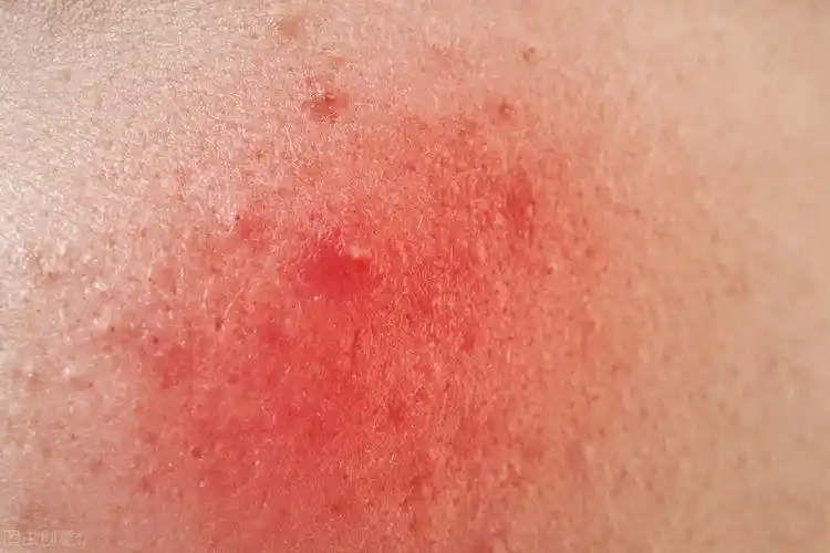 过敏性紫癜的早期症状:皮肤上有红斑,常有腹痛—【nmn观察】