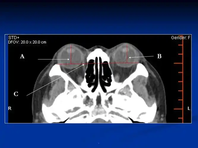 ct眼球突出诊断标准