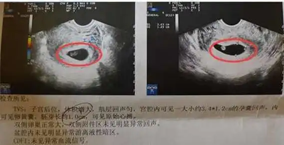 其实看孕囊很准 6一7周孕囊大小看男女