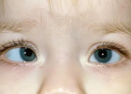 单眼弱视=儿童眼睛隐形杀手