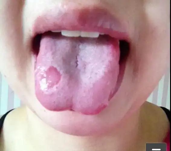 舌头这样正常吗,需要注意什么.