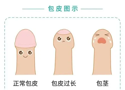 包皮过长和包茎是龟头为包皮所覆盖,原则上说包皮过长可以通过手法将