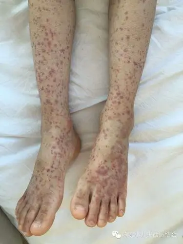 住院患者原创病例(小儿过敏性紫癜)分享_小儿紫癜性肾炎_症状表现