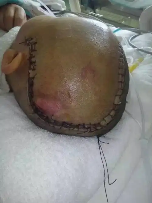 内蒙三岁女童被继母打昏迷已做开颅手术生死未卜