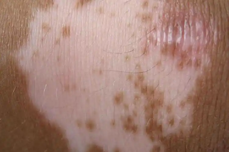 手臂白斑最初期的图片