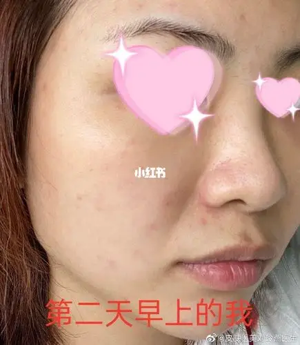 论好好卸妆的重要性!卸的不干净就这样了