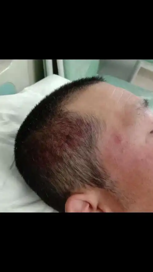 王先生提供的头部受伤照片
