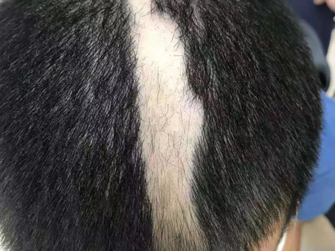 儿童脱发,小心"拔毛癖"