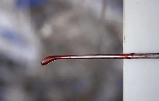 妇科人流手术实拍图