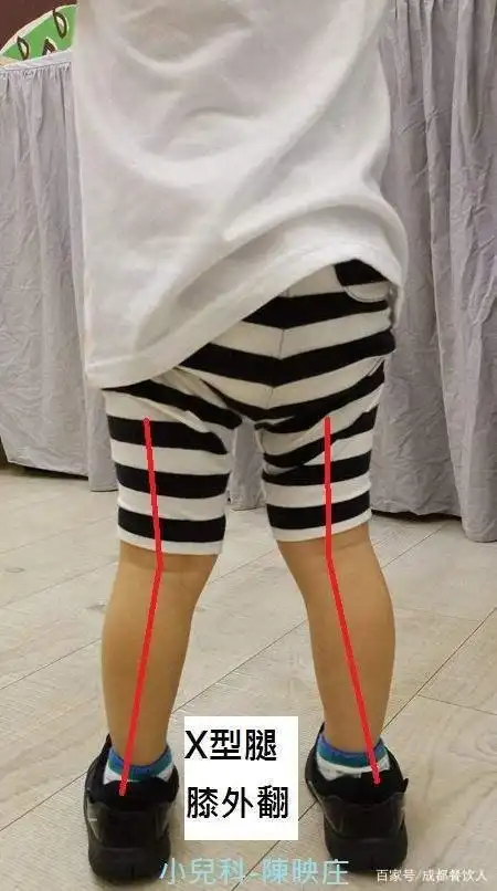 维生素d缺乏引起的x型腿