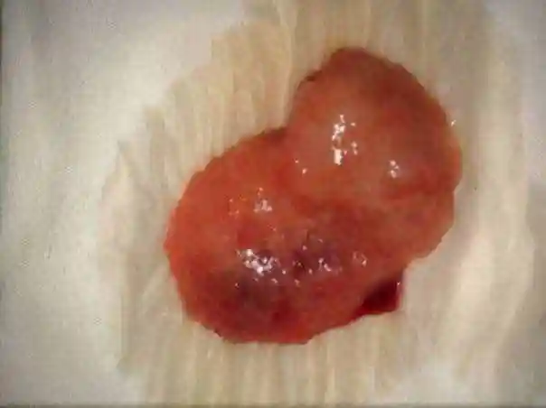 女护士意外怀孕10天不想做手术,选择药物成功做好人流