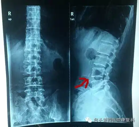 腰椎间盘突出症的影像学检查