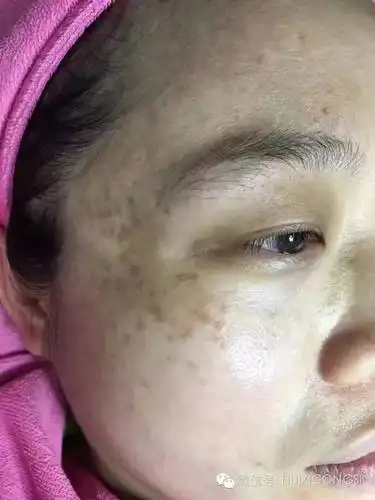 铂钰美颜堂如何祛除真皮斑