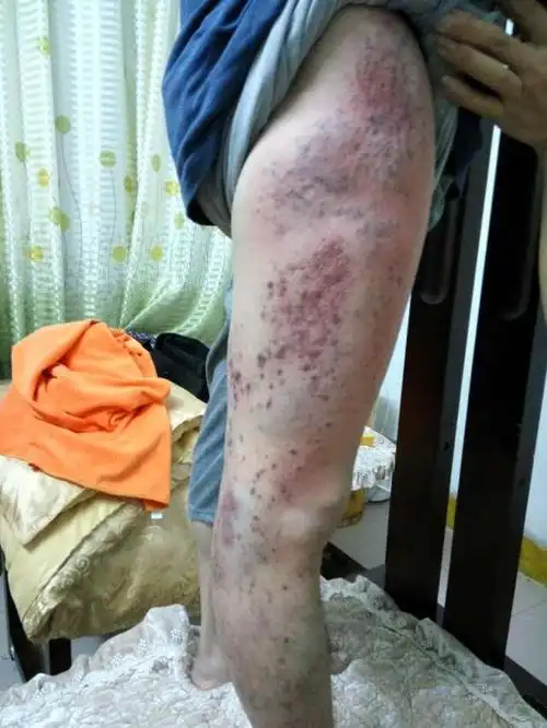 大腿外侧胆经出痧