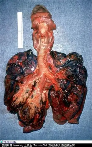 烟肺会是个什么样?有图片么?