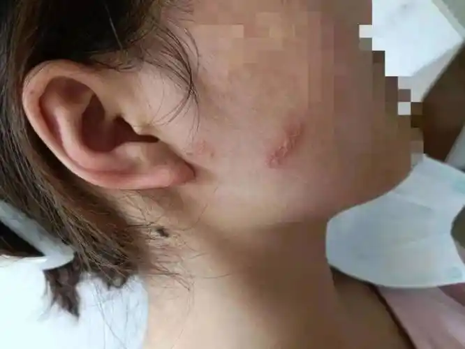 女子夜跑时脸部溃烂险毁容, 幸亏及时赶到长沙鸿业皮肤病专科医院就医