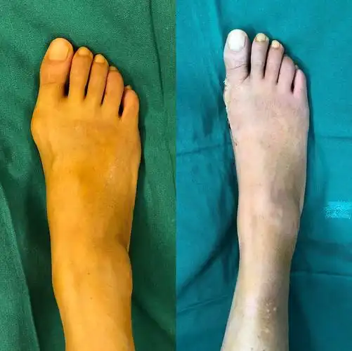 拇外翻病例诊疗分享_拇外翻_拇外翻治疗方式 - 好大夫在线