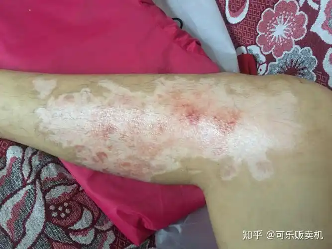 浅二度到深二度烧伤恢复过程记录有图慎点