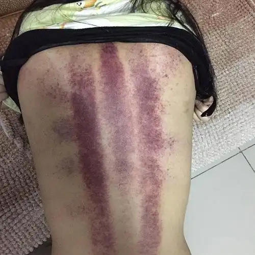 21:21:29 今天下午跟妈妈一起去做了经络排毒 全身痧都是紫黑的 应该