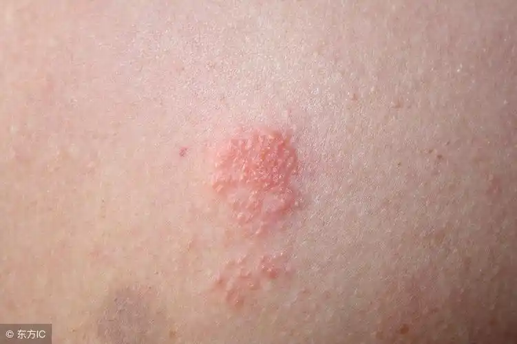 单纯疱疹的临床分型及表现