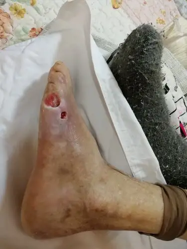 老xuezhen足部伤口负压治疗