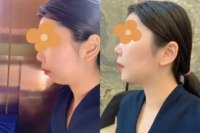 玻尿酸填充下巴经历分享,侧面明显精致,连下颌线也清晰了!