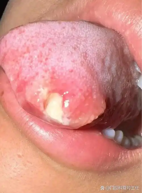 比如吃东西不注意引起的;也可能是生病了,最常见的是舌头溃疡,舌炎