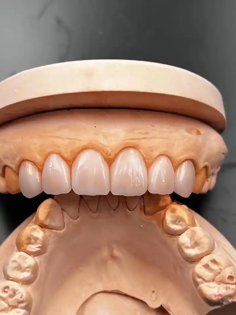 灵魂作品#全瓷贴面 #牙齿美白 #美牙贴面 #全瓷贴片 #海 - 抖音